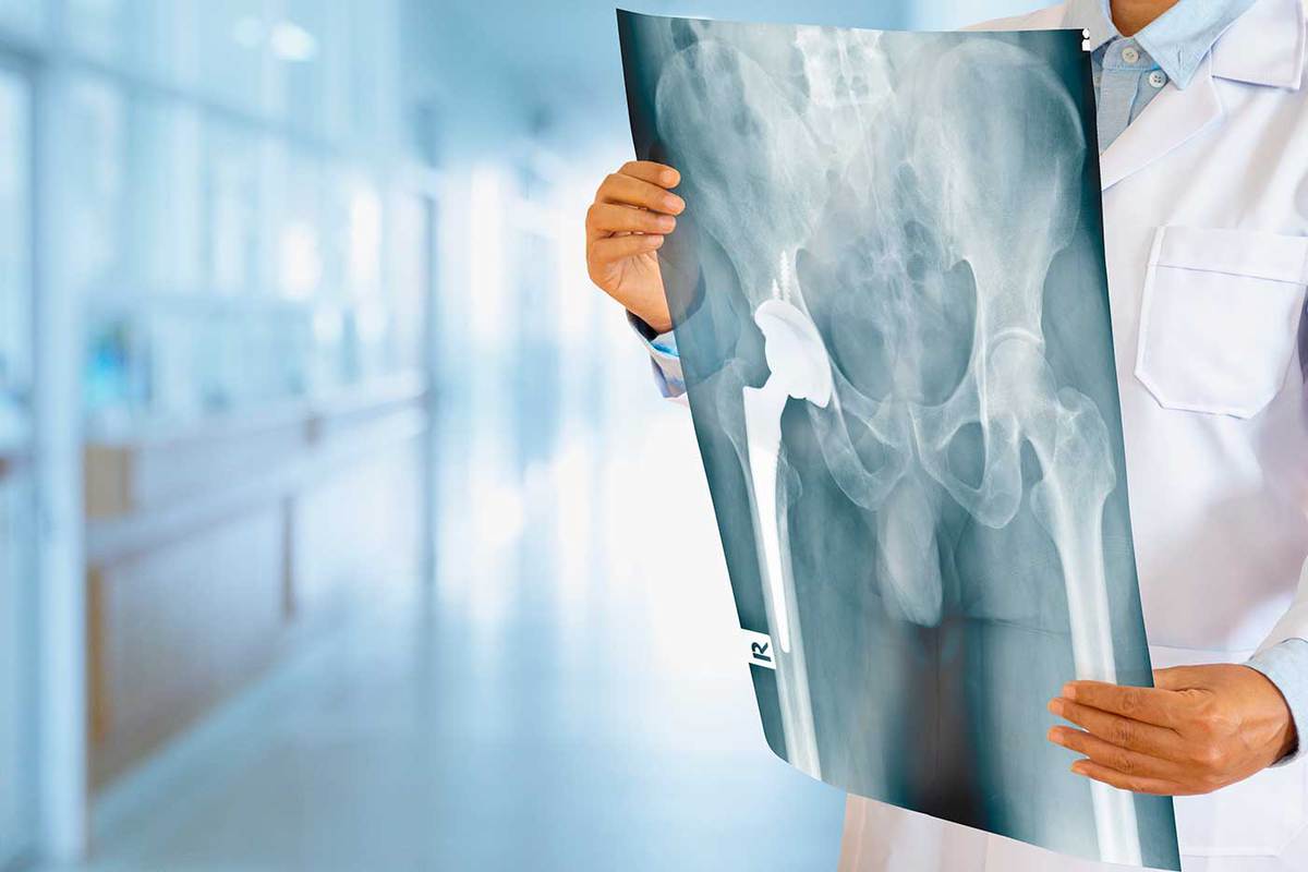 Lucha contra la osteoporosis
