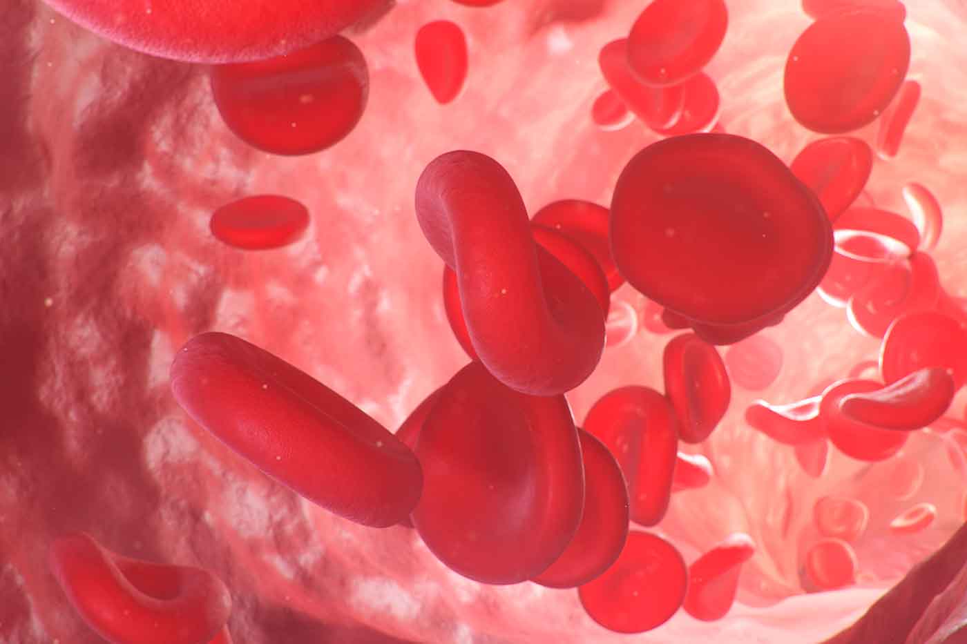 anemia